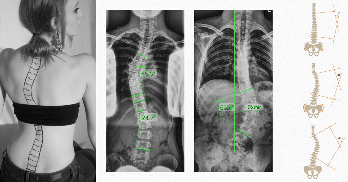 การรักษา Scoliosis Bangkok 20