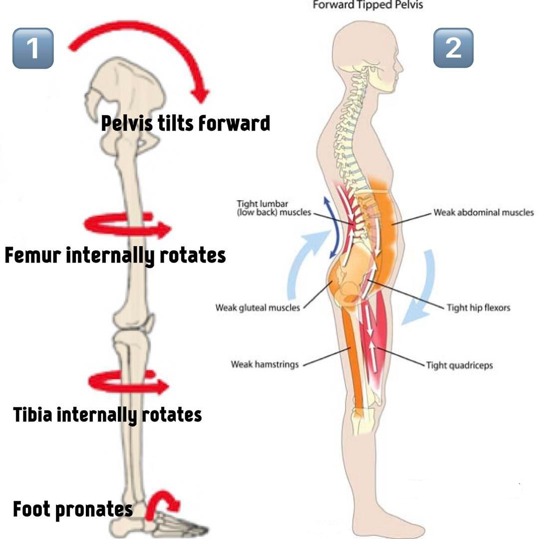 arch support for knock knees